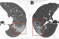Опубликованы снимки пораженных коронавирусом легких